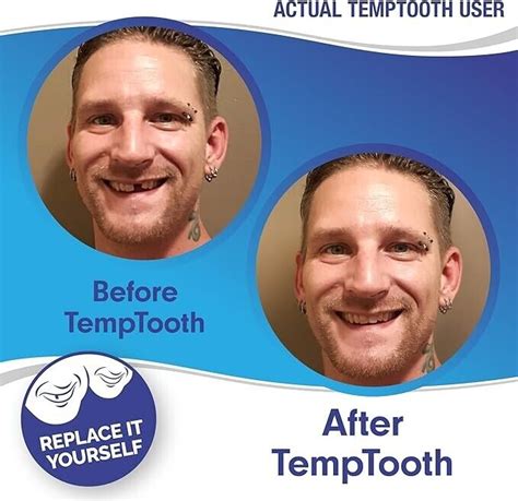 Temptooth Kit Original Temp tooth Missing Tooth Replacement Over ...