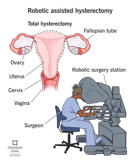 Robotic Assisted Hysterectomy: Procedure, Risks & Recovery