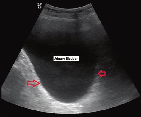 Diverticulum Of Bladder Ultrasound