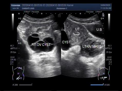 Ultrasound Video showing Two types of Ovarian Cysts and an Ovarian Mass. - YouTube