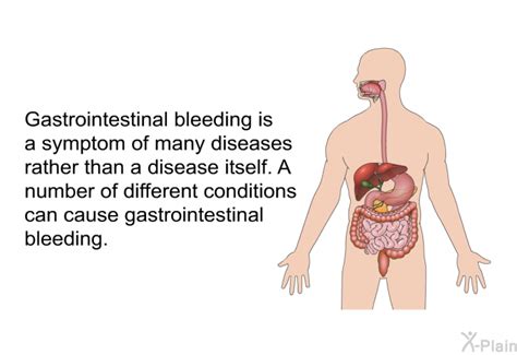 PatEdu.com : Gastrointestinal Bleeding