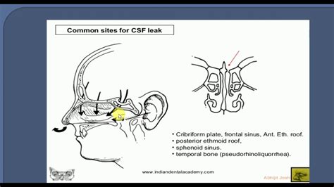 ENT LECTURES , CSF RHINORRHEA - YouTube