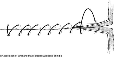 7 Simple continuous suture | Download Scientific Diagram