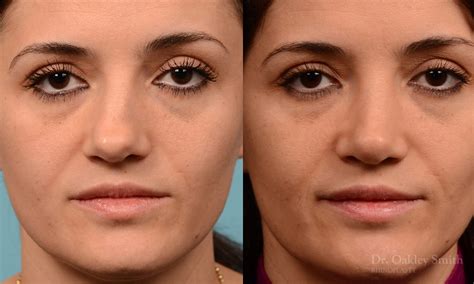 Rhinoplasty Surgeon Ontario Dr Smith, before after 234