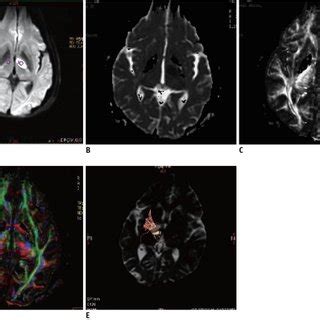 Diffusion weighted imaging and diffusion tensor imaging scans from... | Download Scientific Diagram