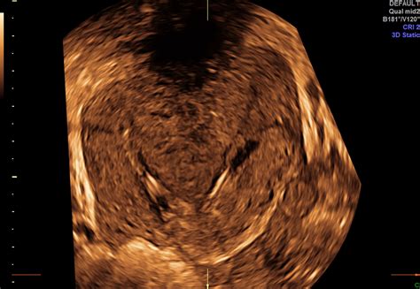 Didelphys Uterus, with CT + MRI correlation. : Radiology