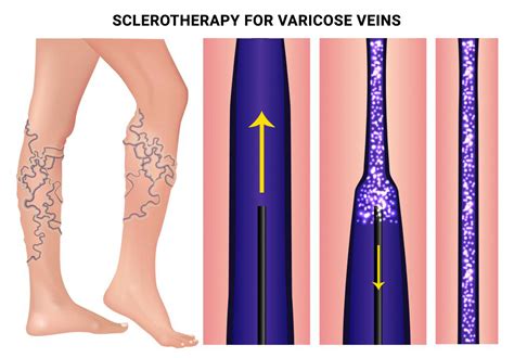 Sclerotherapy for Varicose Veins in NYC & NJ - Vein Care Center