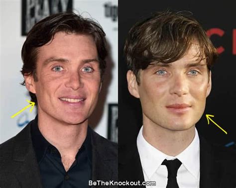 Cillian Murphy Before And After Plastic Surgery