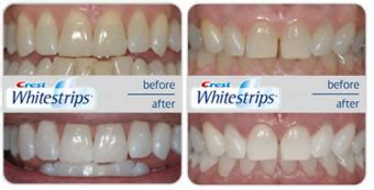 Teeth Whitening with Whitestrips4u.co.uk: Compare the Crest Whitestrips ...