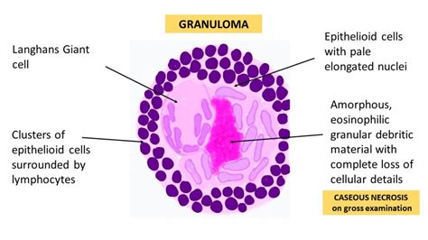 GRANULOMATOUS INFLAMMATION - Pathology Made Simple