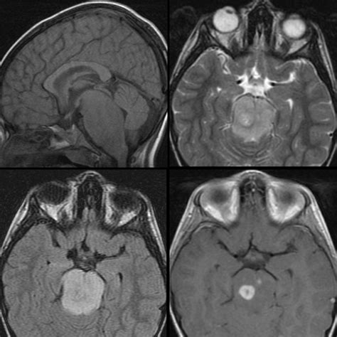 Brainstem Glioma | Pediatric Radiology Reference Article | Pediatric Imaging | @pedsimaging