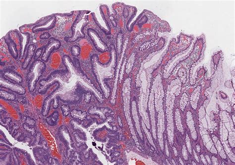 Can A Tubular Adenoma Become Cancerous - CancerWalls