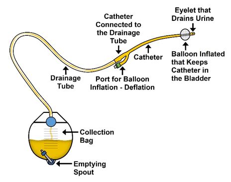 Indwelling Catheter Definition & Types