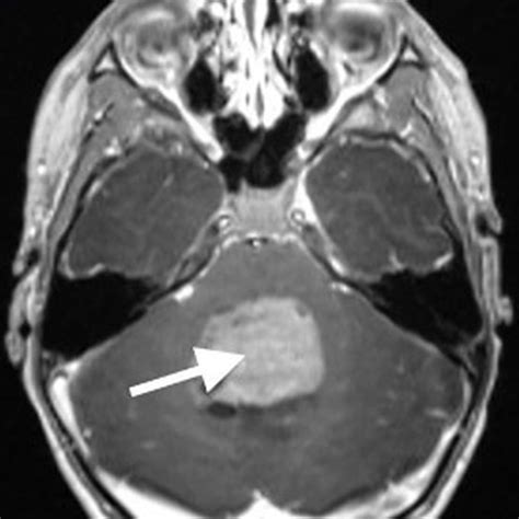 Primary Pediatric Posterior Fossa Tumors: An Illustrative Review - ARRS InPractice