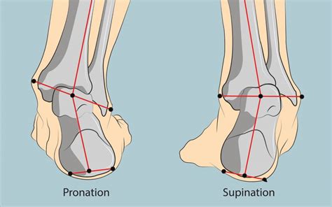 Pronation vs. Supination – Diversified Integrated Sports Clinic