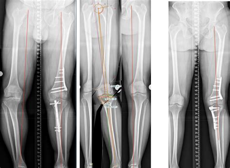 Osteotomy Surgery - Knee Surgery - Northern Knee Clinic