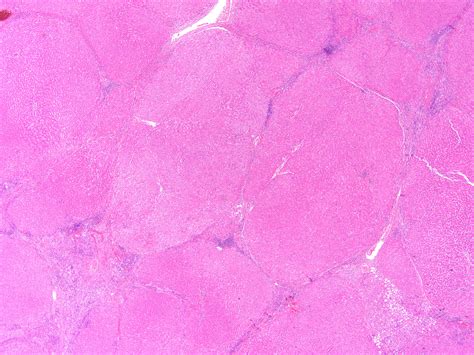 Pathology Outlines - Cirrhosis