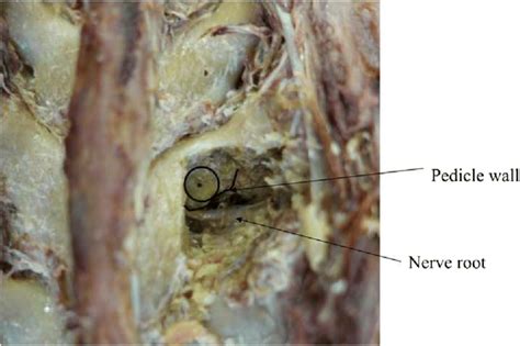 Nutrient foramen penetrating deep into the pedicle | Download ...