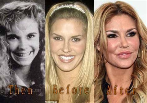 Brandi Glanville Before And After