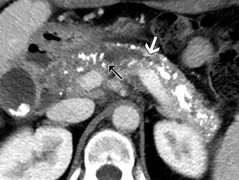 Chronic pancreatitis, causes, symptoms, diagnosis, treatment & prognosis