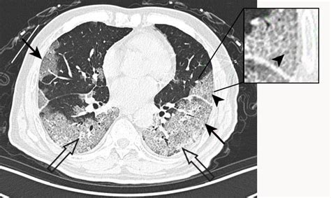 Computed tomography of covid-19 pneumonia | The BMJ