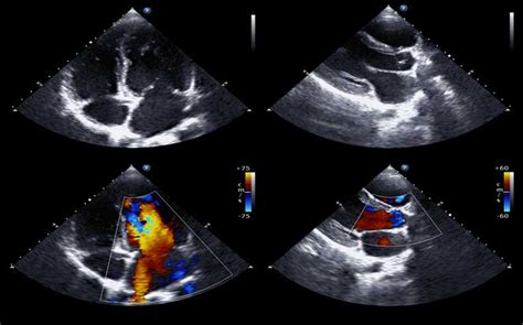 Cardiac Tests: Stress Echocardiogram and Nuclear Cardiology Test ...