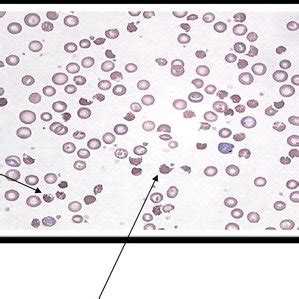 (PDF) Infantile pyknocytosis, a rare cause of hemolytic anemia in ...