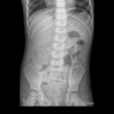The Abdominal XRay: A relic or a reliable tool? — Taming the SRU