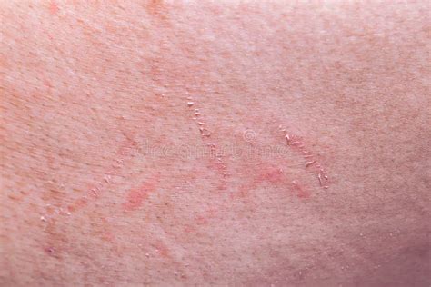 951 Skin Abrasion Photos - Free & Royalty-Free Stock Photos from Dreamstime