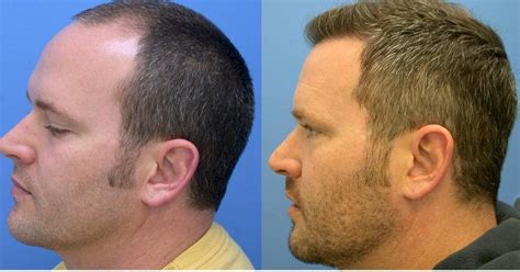 Best hair transplant Los Angeles - Revive hair restoration: Best Hair Restoration in Los Angeles ...