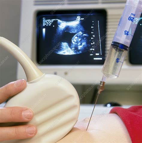 Amniocentesis sampling with needle and ultrasound - Stock Image - M800/0040 - Science Photo Library