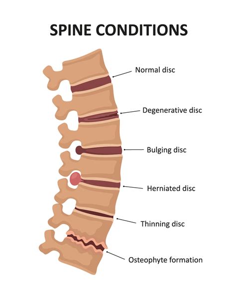 Disc syndrome: Causes, Symptoms and Treatments | ACC