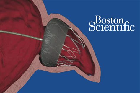 FDA approves Boston Scientific's Watchman anti-stroke device - MassDevice