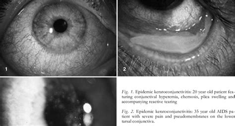 Epidemic keratoconjunctivitis – sequelae: 46 year old patient 7 days ...