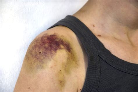 Bruises: Symptoms, Causes, Diagnosis, Treatment, Remedies