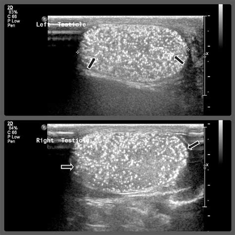 Cureus | Mediastinal Germ Cell Tumor with Testicular Microlithiasis