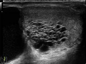 Spermatocele Ultrasound