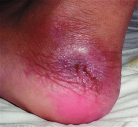 Healing left foot ulcer. | Download Scientific Diagram