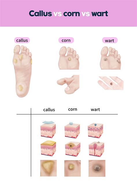 Plantar Wart Vs. Callus Vs. Corn [Plantar Wart Removal & Treatment]