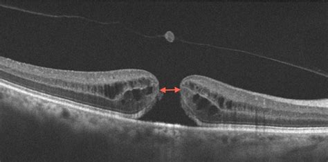 Optical coherence tomography in the preoperative and postoperative ...