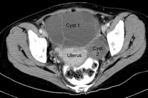 Ovarian endometrioid adenocarcinoma and mucinous cystadenoma ...