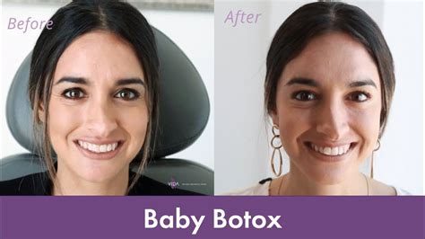 Baby Botox Experience | Getting Botox for the First Time! - YouTube