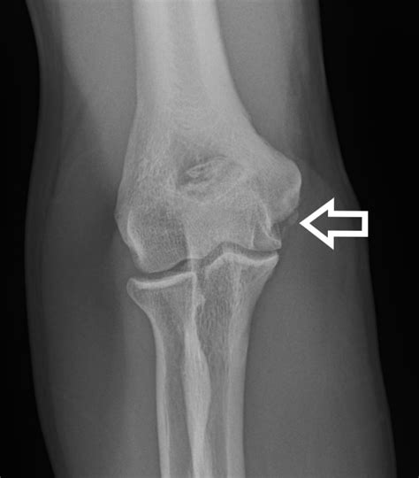 Tommy John Surgery | UCL Injury Overview | Dr. Christopher Ahmad