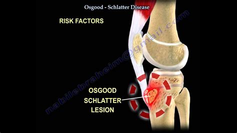 Osgood Schlatter Brace For Kids | Kids Matttroy