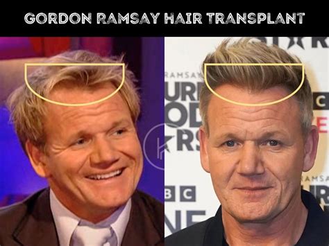 Gordon Ramsay Hair Transplant - Hair Loss & Technical Analysis