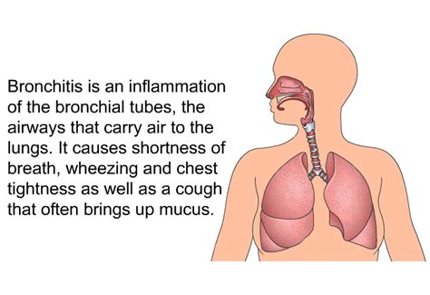 PatEdu.com : Bronchitis