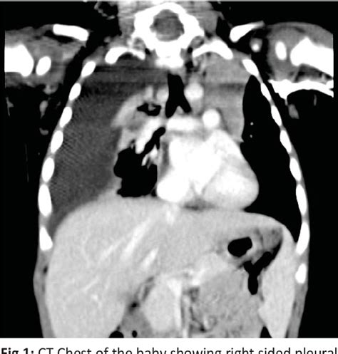 Figure 1 from Idiopathic Chylothorax in Infants - Is Octreotide Alone Enough? | Semantic Scholar