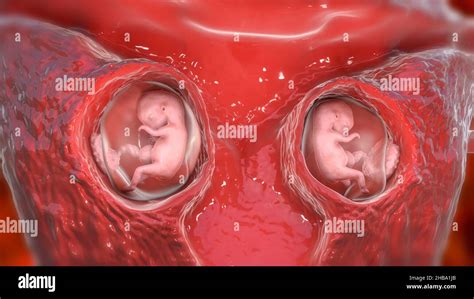 Multiple pregnancy, illustration. Dizygotic twins developing in the uterus separately at week 8 ...