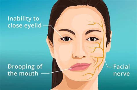 Bell’s Palsy: Symptoms, Risks, Diagnosis and Treatment