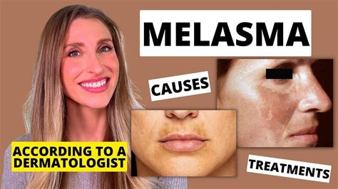 Melasma Treatment: Home Remedies, Prescriptions, Procedures | atelier ...